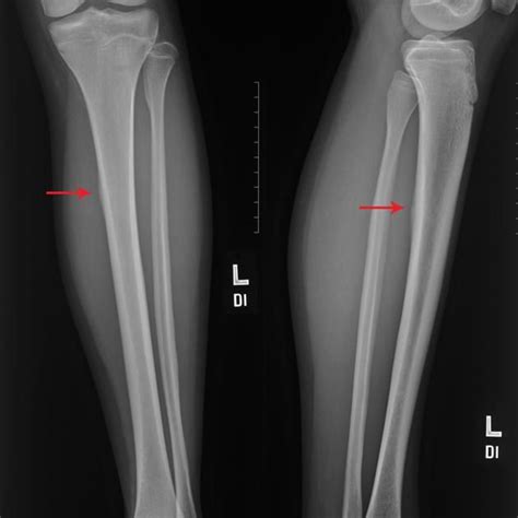 Medial Tibial Stress Syndrome Radiology Case