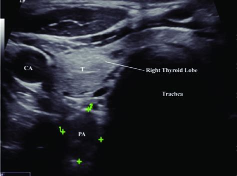 Parathyroid Ultrasound Anatomy