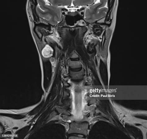 Salivary Gland Surgery Photos And Premium High Res Pictures Getty Images