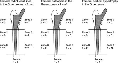 Localization And Incidence Of Femoral Radiolucent Lines Femoral