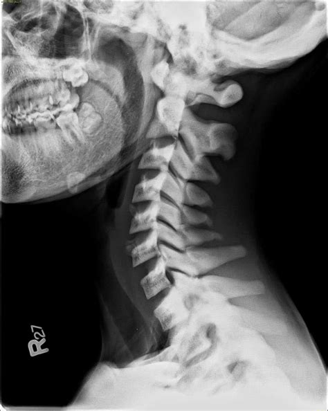 Osteopetrosis X Rays Case Studies Ctisus Ct Scanning