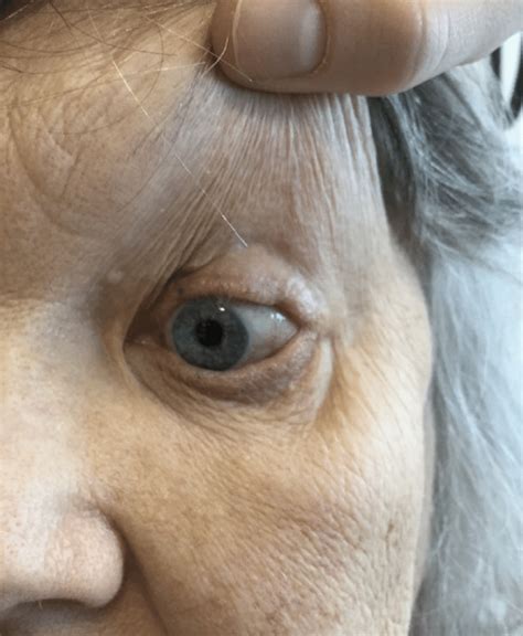 Initial Presentation Of Ocular Cicatricial Pemphigoid Showing