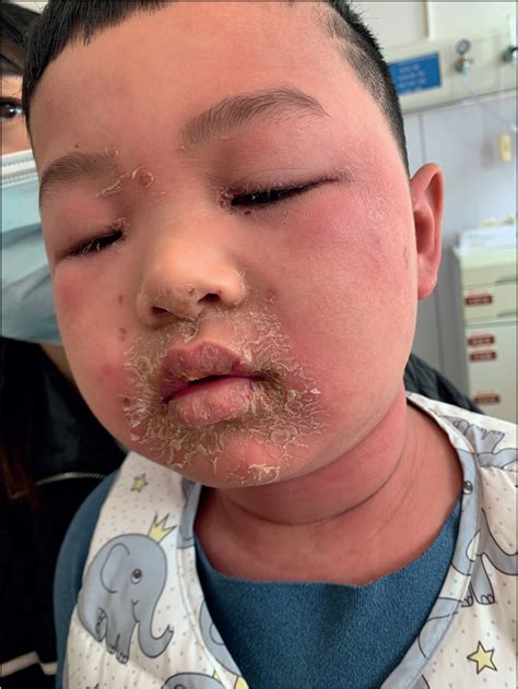 Staphylococcal Scalded Skin Syndrome In A Child The Lancet Infectious