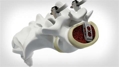 Medtronic Announces Adaptix Interbody System Or Today