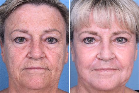 Check Out This Amazing Before And After Of Drsikorskis Patient