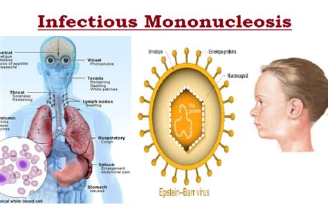 Infectious Mononucleosis Symptoms Goimages 411