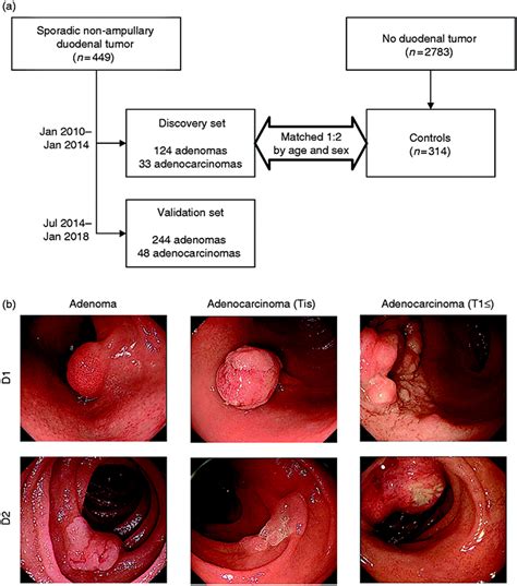 Clinical And Endoscopic Findings To Assist The Early Detection Of