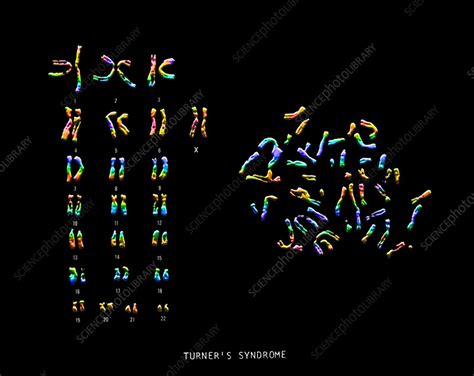 Turner S Syndrome Karyotype Stock Image C Science Photo Library
