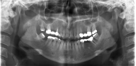 Check spelling or type a new query. Los Angeles Panoramic X-Ray | Best Advanced Dental Imaging