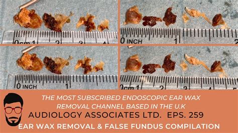 Ear Wax Removal And False Fundus Compilation Ep259 Youtube