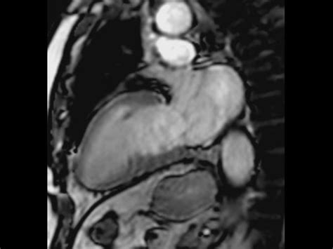 Cardiac Mri Arrhythmia Patient Philips Mr Body Map