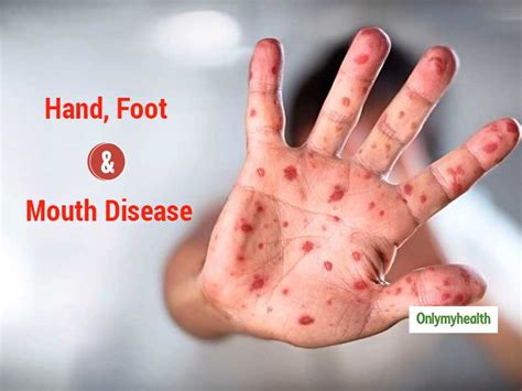 Hand Foot And Mouth Disease Symptoms Causes And Care Tips Onlymyhealth