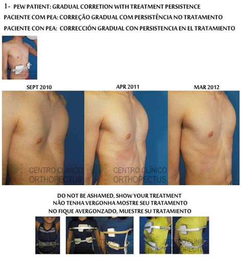 Pectus Excavatum Centro Clínico Orthopectus