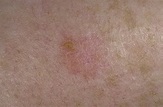 Early Signs of Skin Cancer Pictures – 15 Photos & Images / illnessee.com