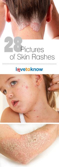 There Are Many Reasons Skin Rashes Occur From Insect Bites To Serious