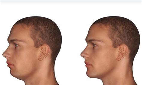 Weak Chin Causes Effects And Improvements Jaw Exercises Facial