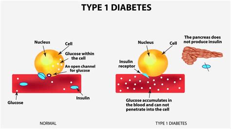 Type 1 Diabetes Symptom Causes Diagnosis And Treatment How To Relief