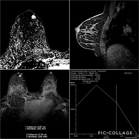 Resonancia Magnética Se Detecta Nódulo En Mama Grupo Ct Scanner