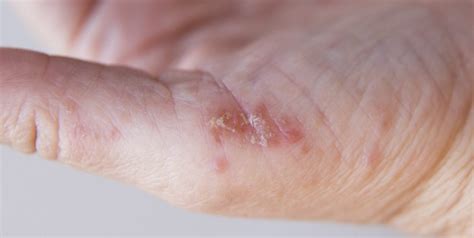 Atopijski Dermatitis Kožna Bolest Pressedan