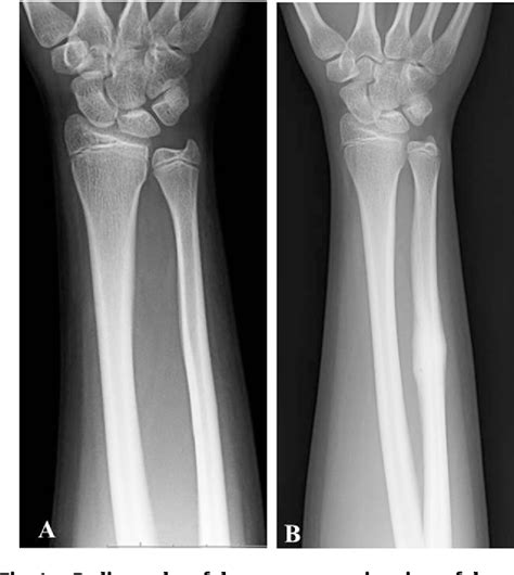 Figure 1 From Stress Fracture Of The Ulna In A Softball