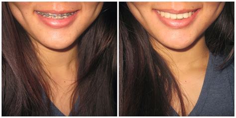 To Flawless Braces Review Before And After