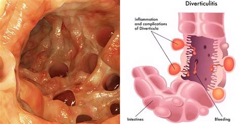 Diverticulosis And Diverticulitis Pictures