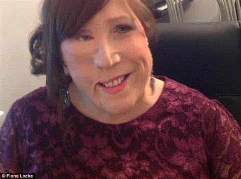 Woman Who Has Had 82 Operations To Correct Facial Deformity Calls End