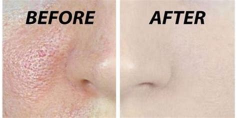Clean And Open Your Pores Naturally With 3 Simple Steps That You Can Do