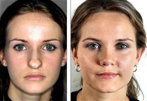 Nose Reshaping Rhinoplasty Or A Nose Job Is Concerned