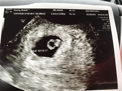 Is It Ok To Have An Ultrasound At 6 Weeks Ababyw