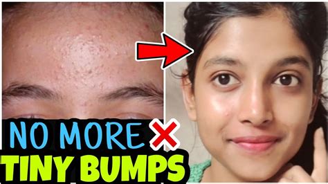 7 Days Challenge 😍treat Tiny Bumps Naturally At Home Youtube