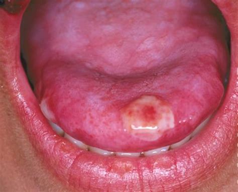Blisters On Tongue Blisters Under Or Side Of Tongue Causes And Treatment