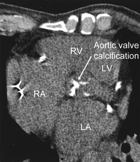 Aortic Valve Calcification As A Marker For Aortic Stenosis Severity