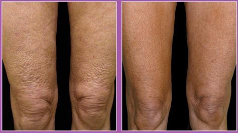 Thermage For Legs And Thighs Dr Michele Green Md