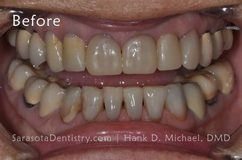 How To Fix Black Triangles In Teeth Sarasota Dentistry