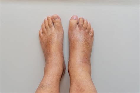 Are Swollen Feet A Sign Of Heart Failure