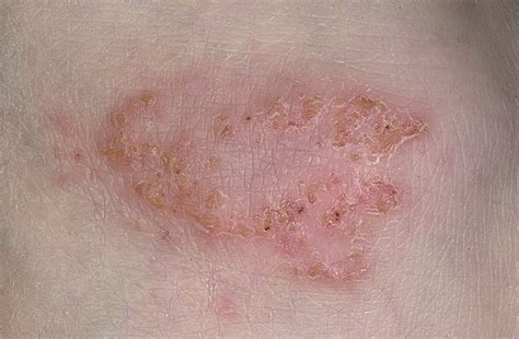 Bacterial Eczema Pictures 41 Photos And Images