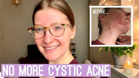 My Experience With Adult Cystic Acne Youtube