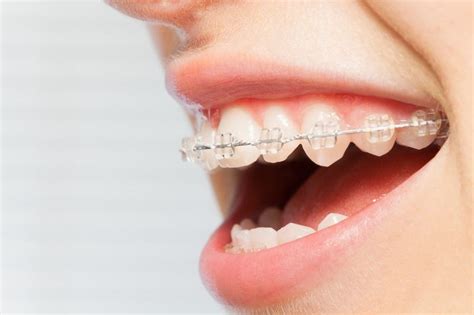 Can Braces Fix An Underbite Orthodontist In Plano Tx