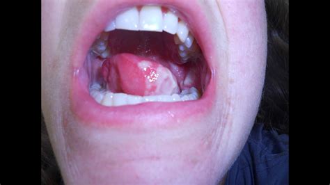 Tongue Cancer Image Gallery