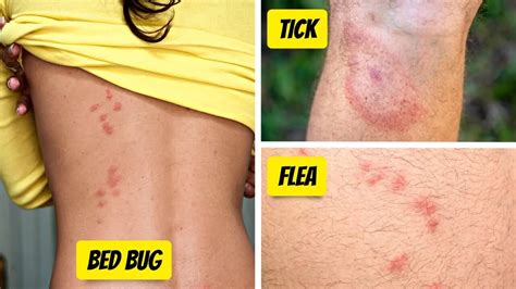 What Bit Me How To Identify The Most Common Bug Bites