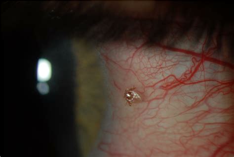 Slit Lamp Photograph Of The Right Eye Of The Patient Revealing A Tick