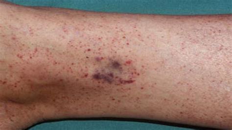 Petechiae Symptoms Causes Sizes And Treatments Health Digest