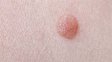 Warts Vs Skin Cancer Can A Wart Be Skin Cancer