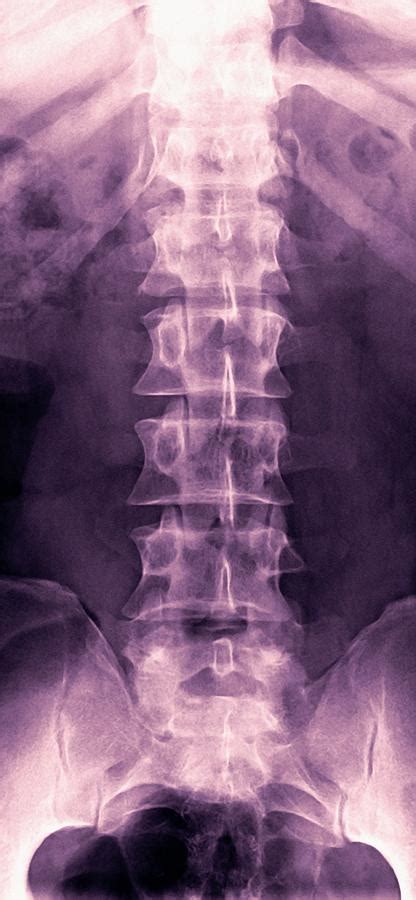 Normal Lumbar Spine X Ray Photograph By Miriam Maslo