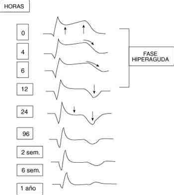 Diagn Stico Del Infarto Agudo Del Miocardio P Gina De