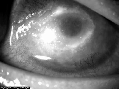 The Right Eye Showing Marked Mixed Conjunctival And Ciliary Injection