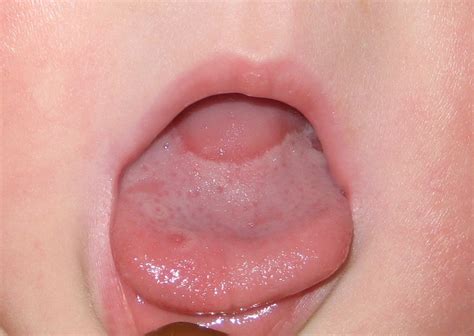 Geographic tongue = اللسان الجغرافي