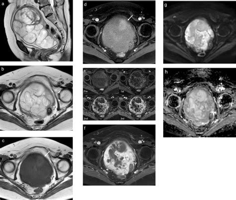 Magnetic Resonance Imaging Findings Of A Myxoid Leiomyosarcoma Of The