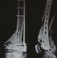 Distal Femoral Fractures: Complications and How to Avoid them? – Trauma ...